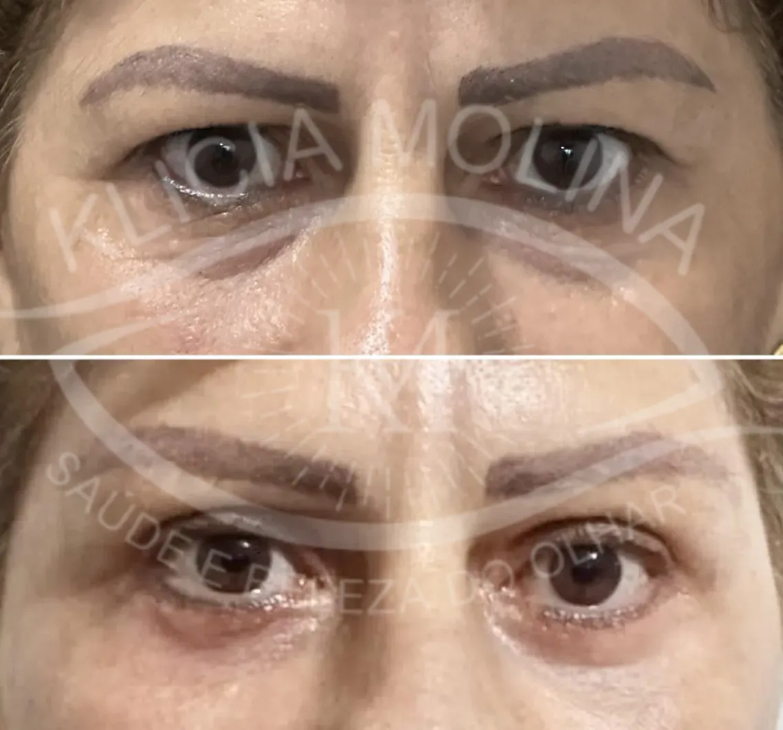 blefaroplastia_3