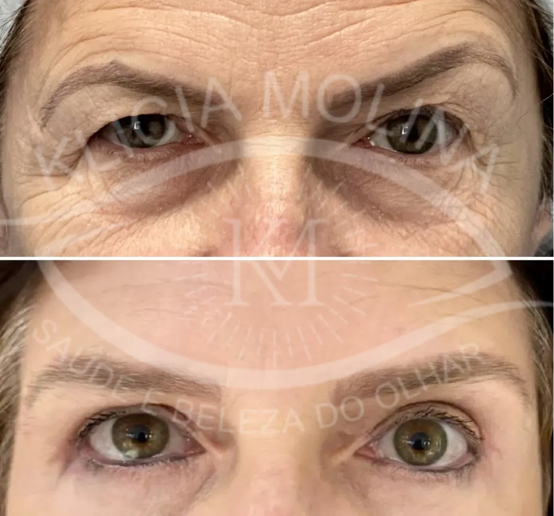 blefaroplastia_4