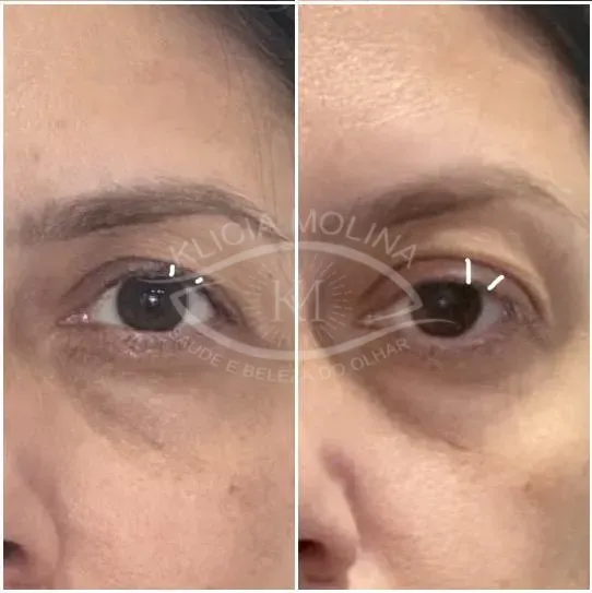 Região da pálpebra a ser maquiada com sombra mais aparente e o rímel parando de borrar!