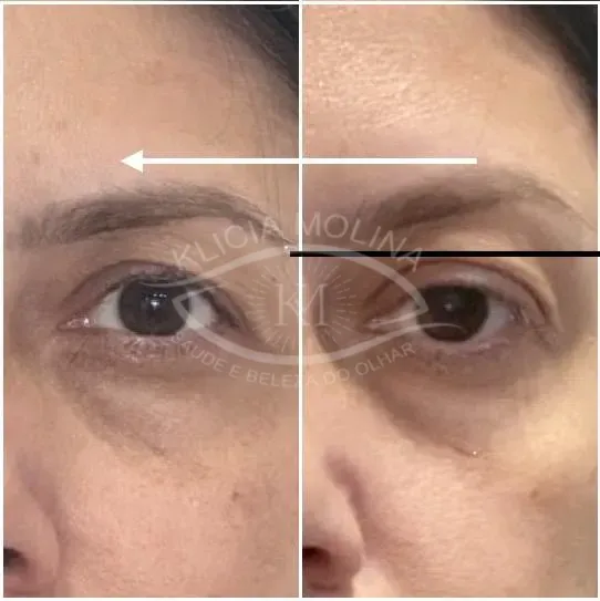 Elevação da pontinha da sobrancelha , deixando o olhar mais aberto e iluminado